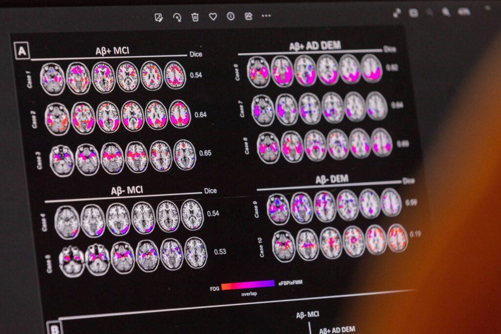 novo-medicamento-para-alzheimer-e-rejeitado-por-agencia-europeia