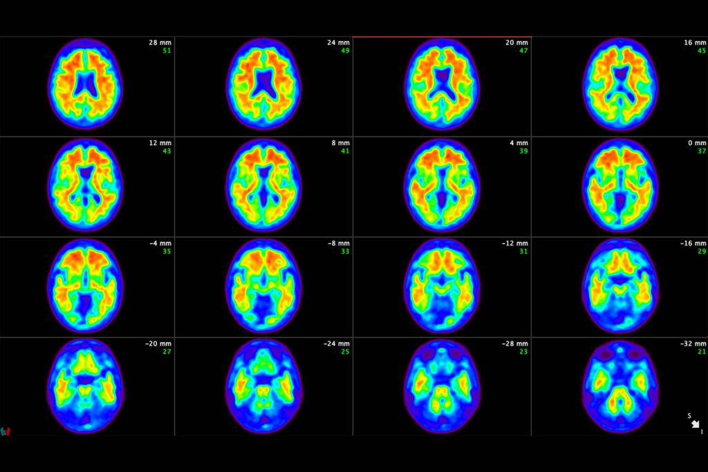 exame-de-sangue-detecta-alzheimer-com-mais-precisao-do-que-medicos,-diz-estudo