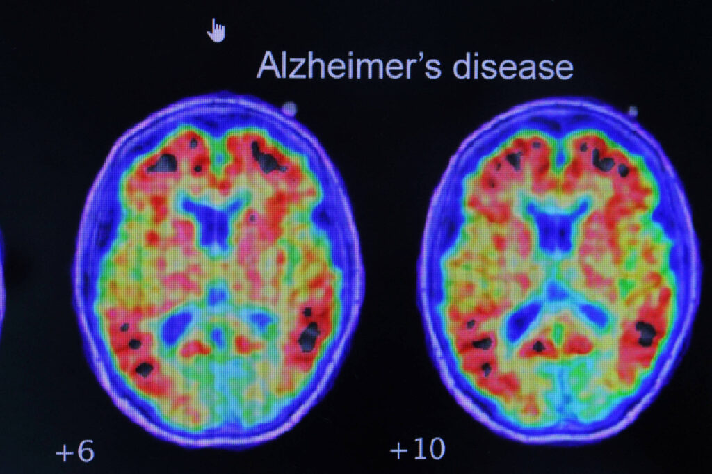 cientistas-desenvolvem-spray-nasal-que-elimina-proteina-ligada-a-doenca-de-alzheimer