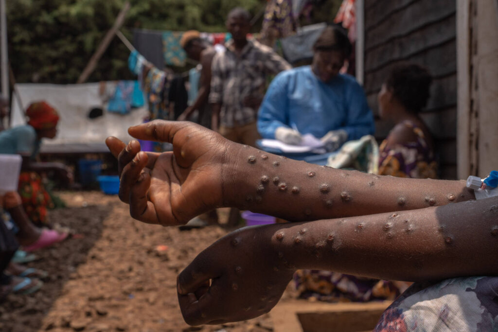 mais-da-metade-dos-casos-de-mpox-no-brasil-esta-no-estado-de-sao-paulo