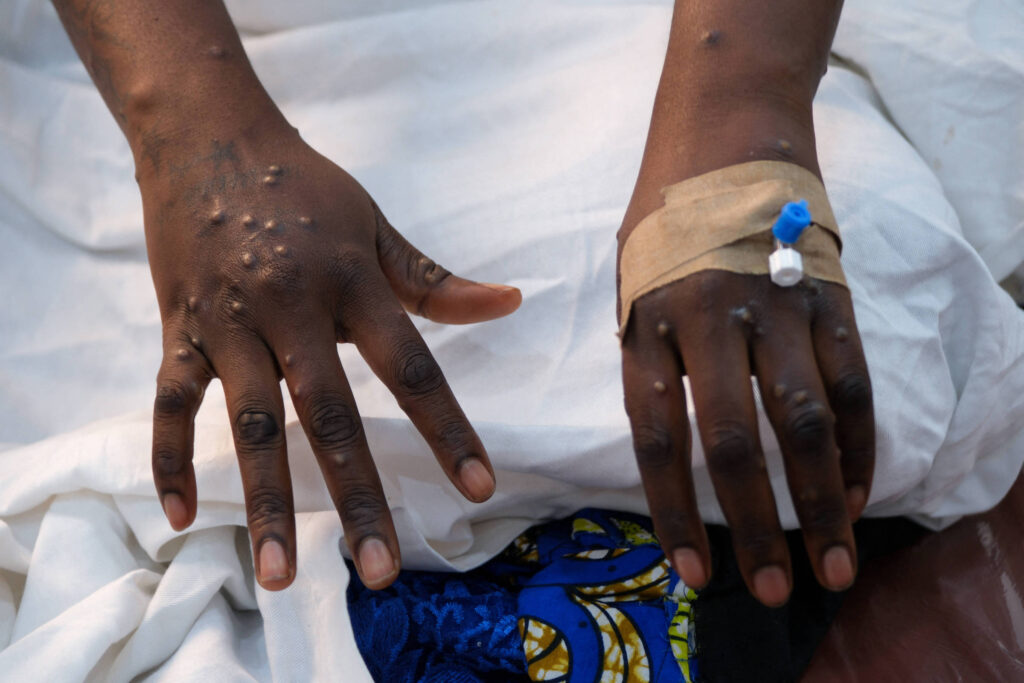 casos-de-mpox-em-2024-ja-superam-total-de-2023