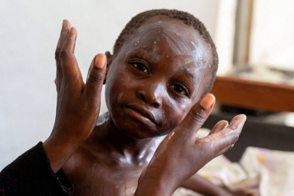 combater-o-estigma-da-mpox-e-fundamental-para-acabar-rapidamente-com-o-surto-no-burundi,-diz-unicef