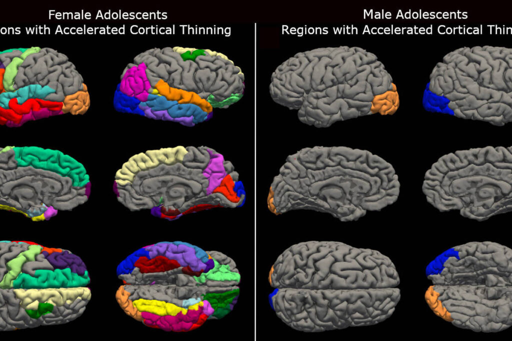 cerebros-de-meninas-adolescentes-envelheceram-mais-rapido-durante-a-pandemia,-diz-estudo